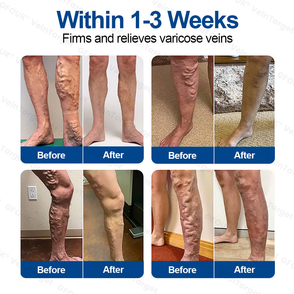 🇨🇦🍁👨‍⚕️✨ CURALONA® VeinTarget Microneedle Patch ⚡ Fast Relief, Long-Lasting Support