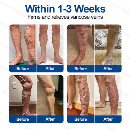 🇨🇦🍁👨‍⚕️✨ CURALONA® VeinTarget Microneedle Patch ⚡ Fast Relief, Long-Lasting Support